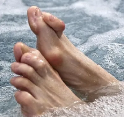 hammertoes, toe pain, toe deformity, cross over toe, bunion