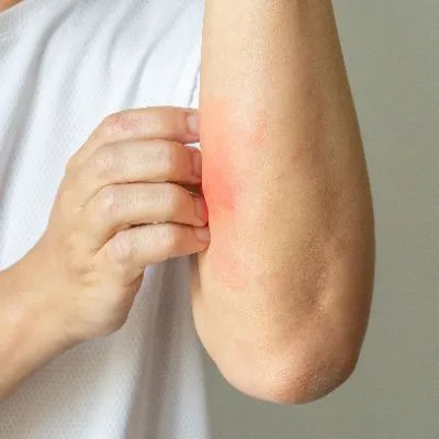 Clinical Studies for Psoriasis