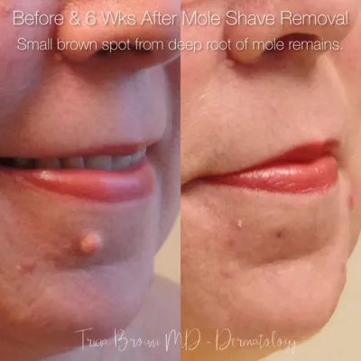 mole removal cream before and after