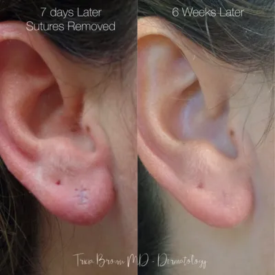 Earlobe Repair - The Complete Awesome Guide with Tips and