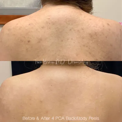 Chemical Peel In Atlanta