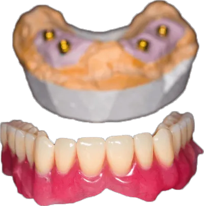 General dentistry full dentures partial dentures at Jenny Ngai, DDS Award Winning Local Edmonds Dentistry