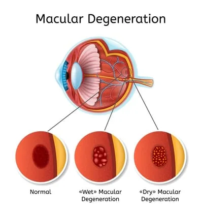 Macular Degeneration Diagram