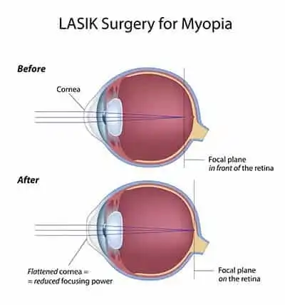 Lasik Surgery for Myopia