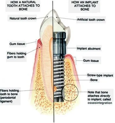 tooth vs. implant