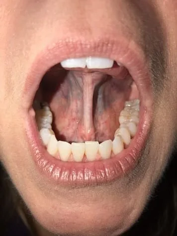 Tongue Tie