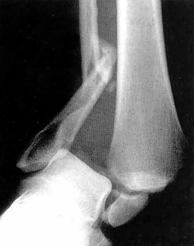 ankle fracture