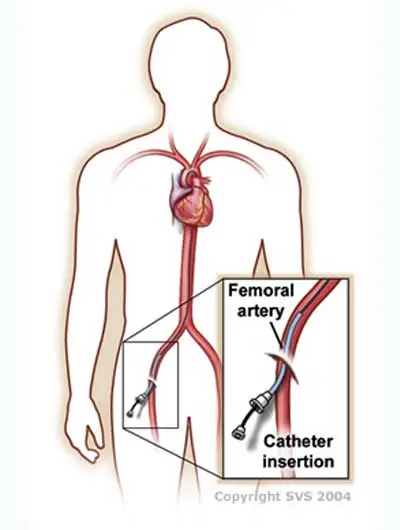 Angiogram