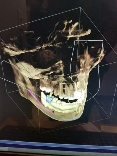 Implant Dental Imaging 1