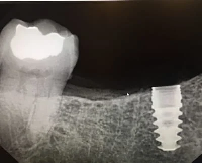 Implant Dental Imaging 5