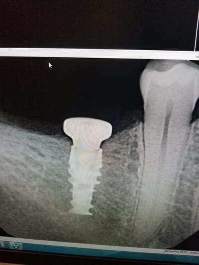 Implants Dental Imaging 3