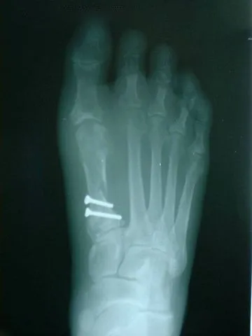 bunion surgery post op