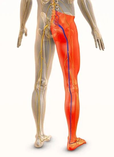 Sciatica-Treatment-in-Poughkeepsie-NY