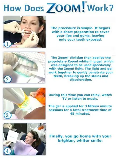 infographic showing step by step photos and text on how Zoom! whitening works, zoom teeth whitening Newark, CA dentist