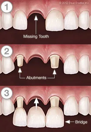 Scarborough Dental Bridges services