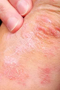 Psoriasis in Manalapan, NJ 