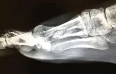 Surgical correction of elevated and comminuted 1st metatarsal fracture with bone graft, screws, plates, and k-wires since removed.