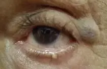 papilloma eyelid