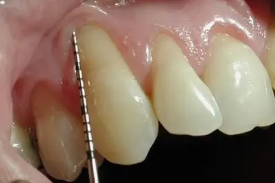 Gum Recession- Alloderm