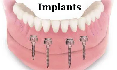 Implants