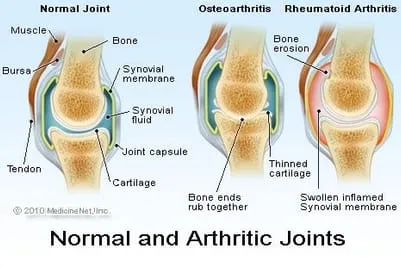 arthritic joints image