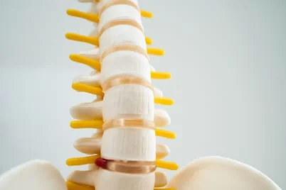 Lumbar spine displaced herniated disc fragment bone artificial model