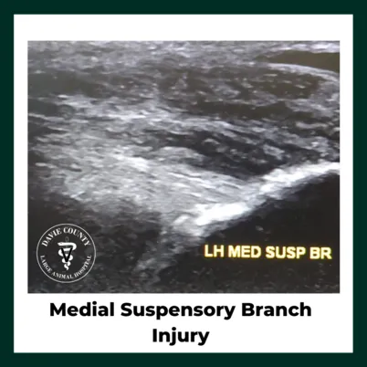 MedialSuspensoryBranchInjury