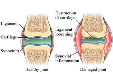 healthy vs damaged joint