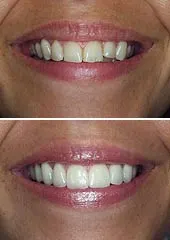 before and after results dental bonding, cosmetic dentistry Mahwah, NJ
