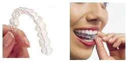  Invisalign