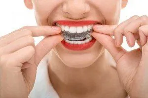 Customized Whitening Trays