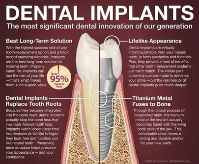 infographic of benefits of dental implants San Antonio, TX