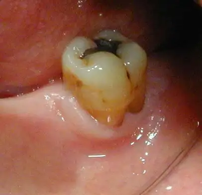 Pittsburgh periodontist picture before crown lengthening to expose decay