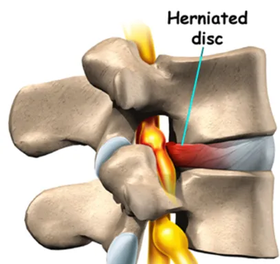 Herniated Discs Treatment In The Woodlands