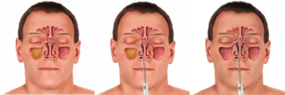sinus dilation