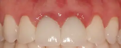 Pittsburgh periodontist before crown lengthening red swollen gums