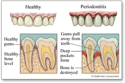 Periodontitis Treatment from Vista Dental in Medicine Hat, AB