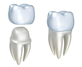 illustration of tooth and roots with tooth prepared to received crown, dental crowns Harrisburg, PA dentist