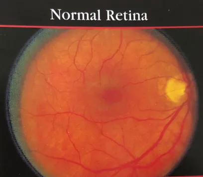 Normal retina