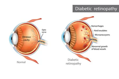 diabetic diseases