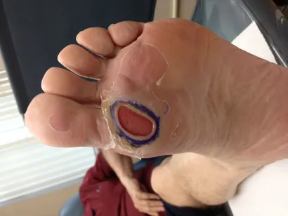 Diabetic Wound Before Dermagraft