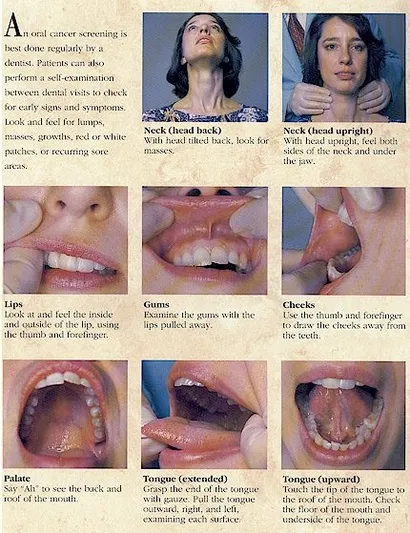 Oral Cancer Self Exam