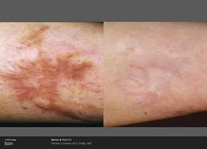 The Skin Wellness Dermatology and Laser Clinic - 🌿Melanogenesis for  hypopigmented leg scars🌿 Leg scar treatments are specific and delicate. It  is vital to look at the kind of scar and treat