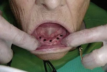 Dental Implants with Screw Retained Denture