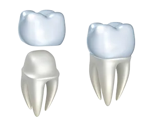 illustration of dental crown fitting over tooth, dental crowns Salem, OR dentist