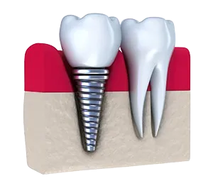 dental implant embedded next to natural tooth, implant dentist Dayton, OH