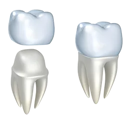 illustration of crown fitting over tooth, dental crowns Decatur, IL dentist