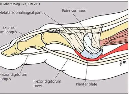  flexor plate foot injury