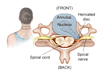 neck disc injury Sheboygan