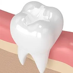 illustration of tooth with composite tooth-colored filling in it, dental fillings Albuquerque, NM cosmetic dentist